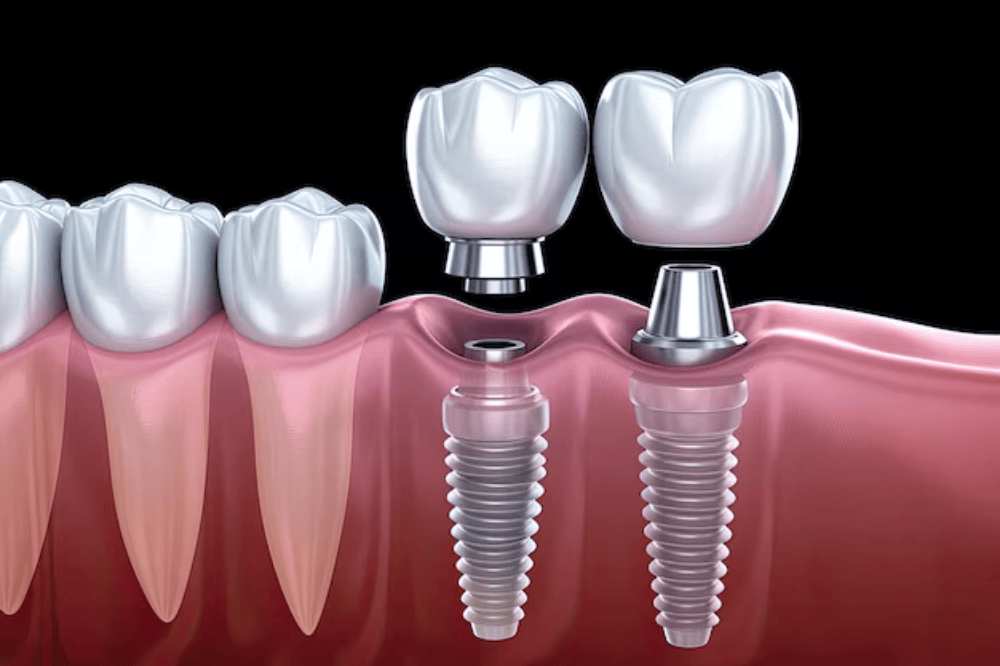 Dental Implant Loading Protocols
