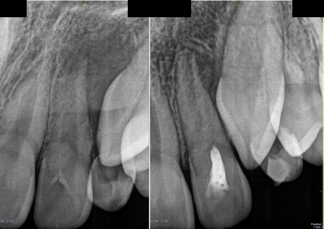 Revascularización Pulpar