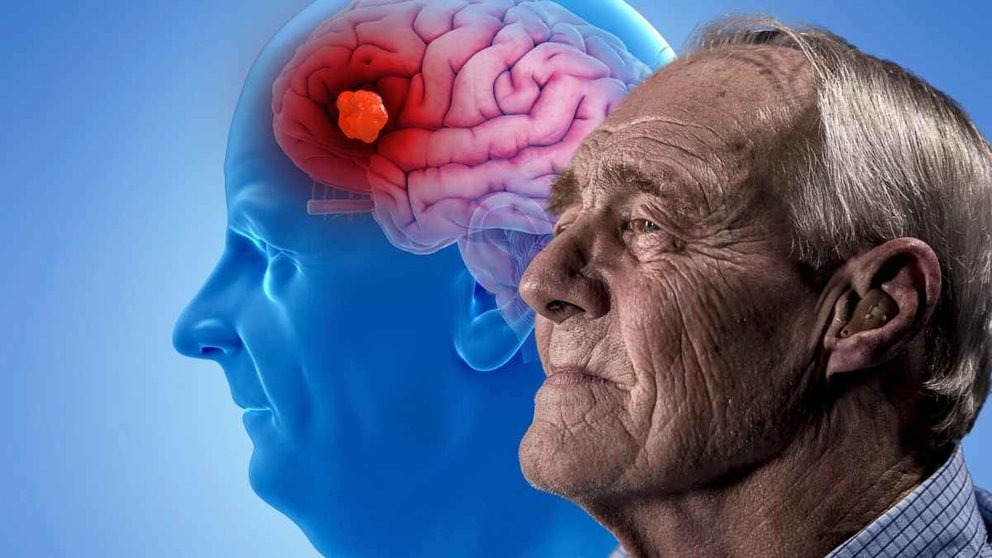 Siestas diurnas excesivas podrían ser un riesgo de padecer Alzheimer