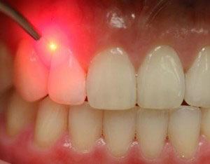 Laser Gum Treatment