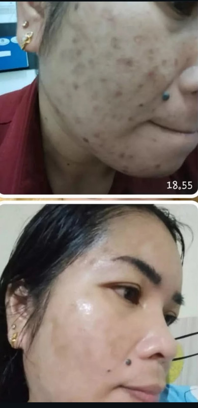 Hasil sebelum & selepas guna Hanaskin