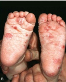 Clinical photograph showing papules, vesicles, and scaling on the sole and foot of an infant, characteristic of scabies in young children