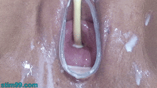 Cervix Dilatation Inflation with Catheter into Uterus