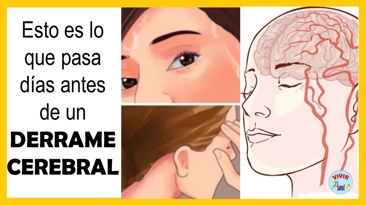 ¿Cómo prevenir un derrame cerebral en tus hábitos diarios?