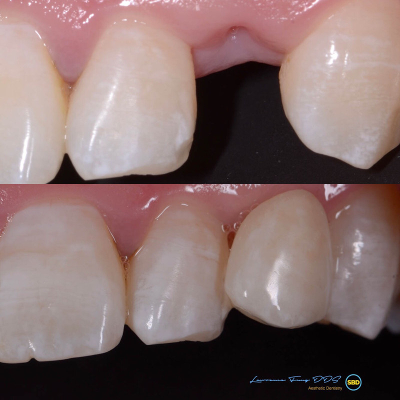 Single Tooth Replacement