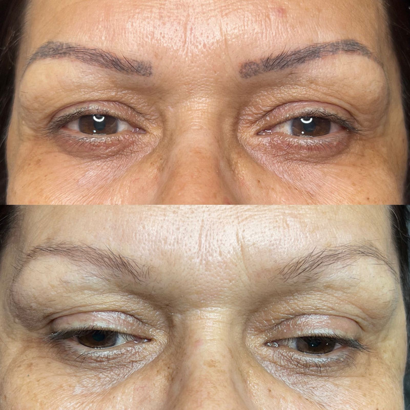 Remoção a laser de micropigmentação