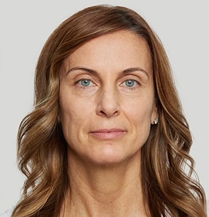 Before Sculptra treatment at Let's Face It Med Spa