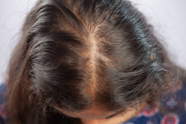 Hairfall