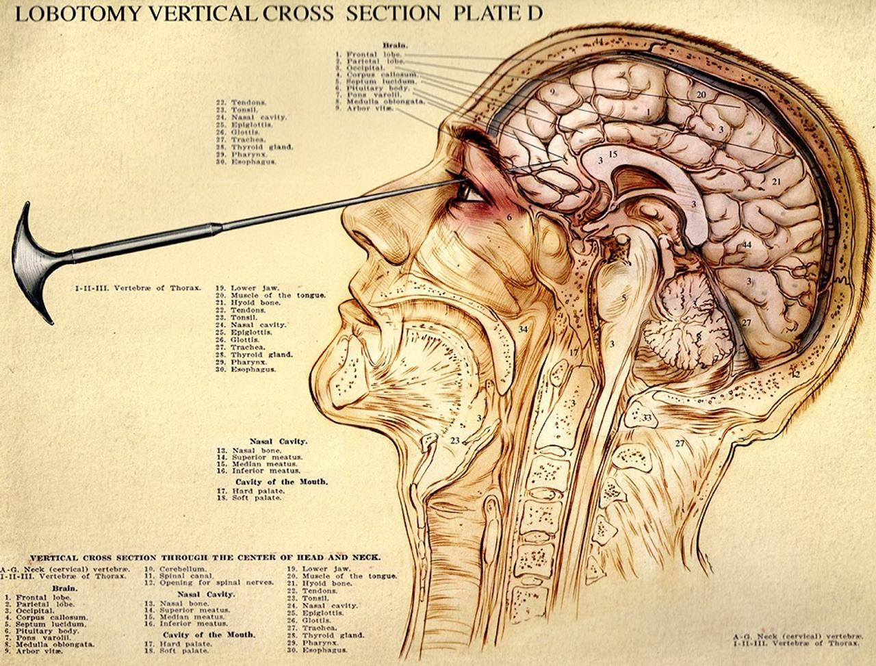 lobotomy