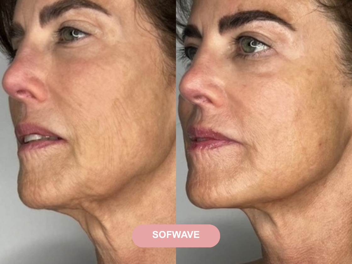 Dermal filler before and after results at Let's Face It Med Spa