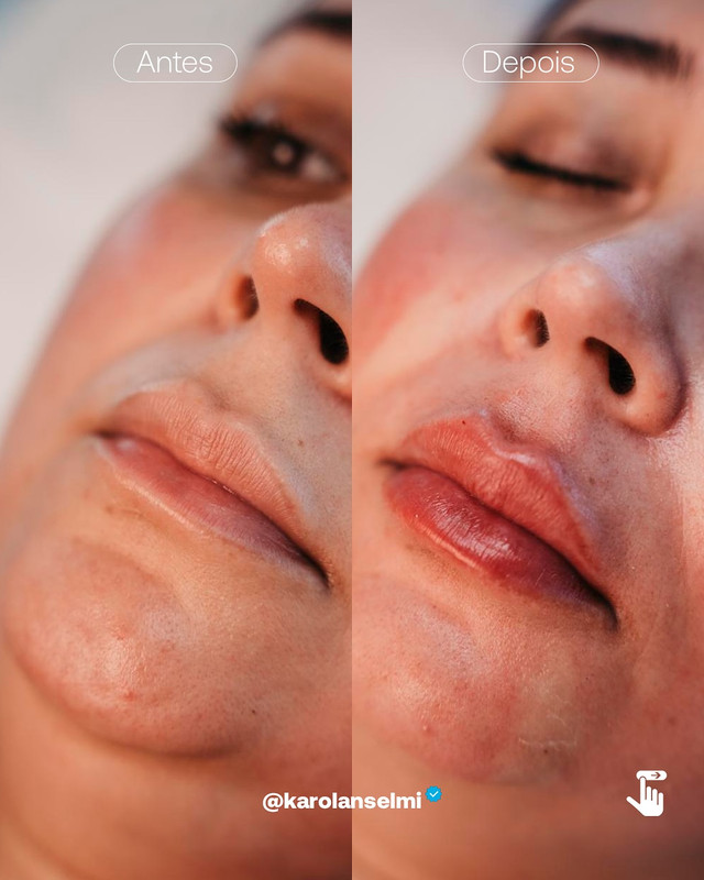 Antes e Depois - Labial