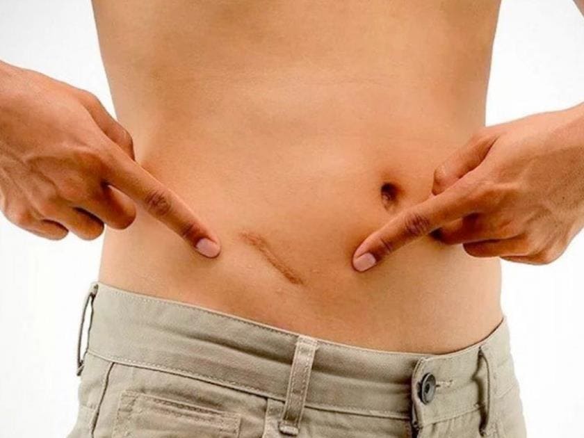 Аппендикс: Не бесполезный рудимент! Удивительные тайны вашего "бактериального хранилища" Аппендикс: Не бесполезный рудимент! Удивительные тайны вашего "бактериального хранилища"