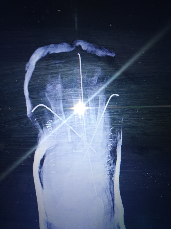 Puedo Quitarme La Bota Walker Para Dormir