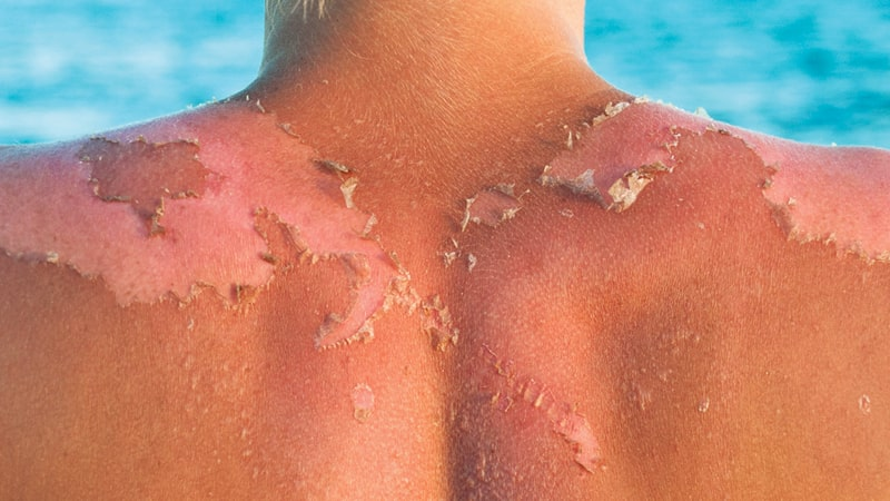 Exposición al sol sin protección puede afectar la piel de los niños con los años