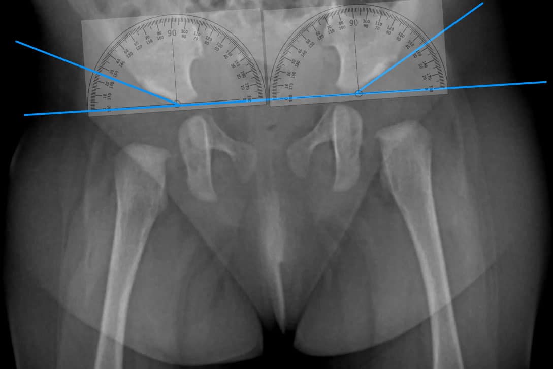 дисплазия-слева